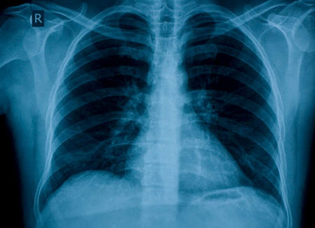 cancro al polmone